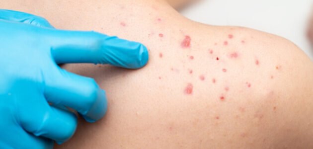 تجربتي مع الحبوب الحمراء على الجلد أسبابها وطرق علاجها